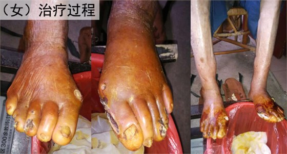 脉管炎女治疗过程