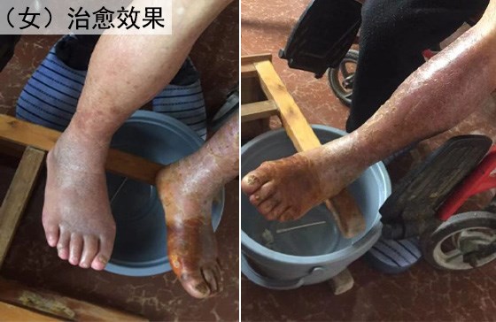 脉管炎女治愈效果