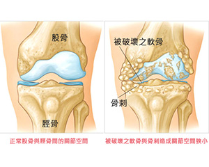 退化性关节炎