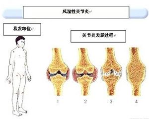 风湿性关节炎
